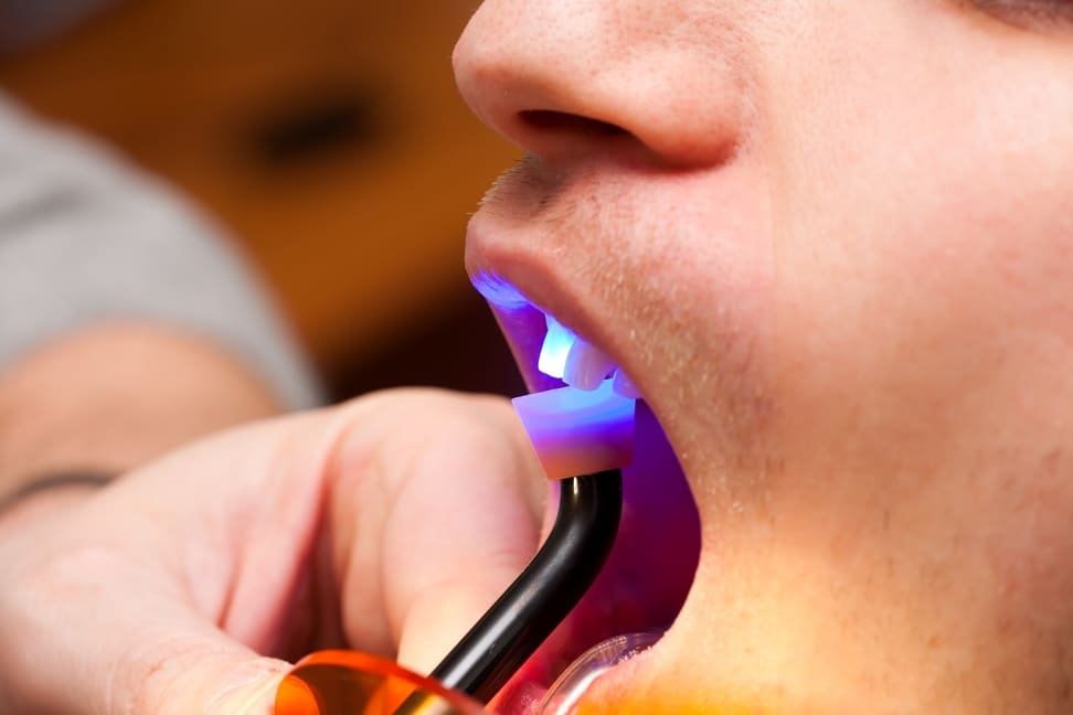 Bonding zębów – co musisz wiedzieć