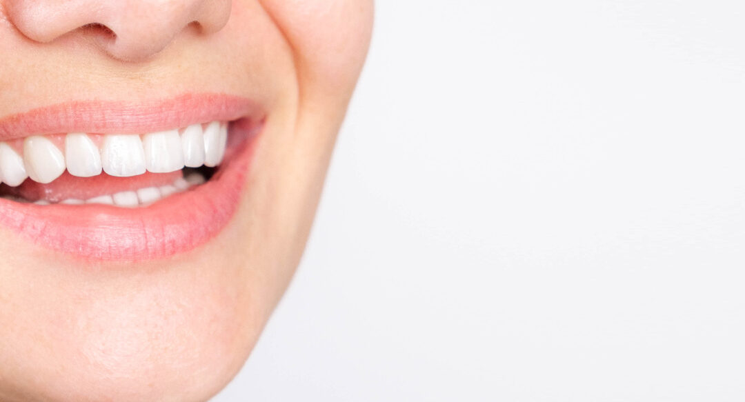 Różnice między klejeniem zębów a licówkami dentystycznymi