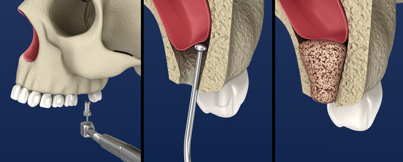 Regeneracja kości pod implanty dentystyczne