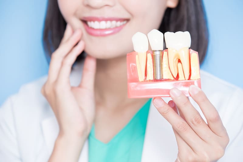 5 największych mitów na temat implantów stomatologicznych